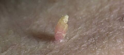 papilloma um Penis wéi ze läschen