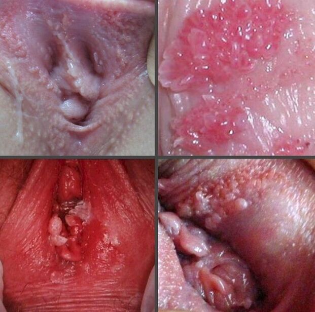Close-up vu Papillome an der Vagina