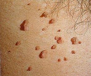 Mënsch Papillomavirus op der Haut