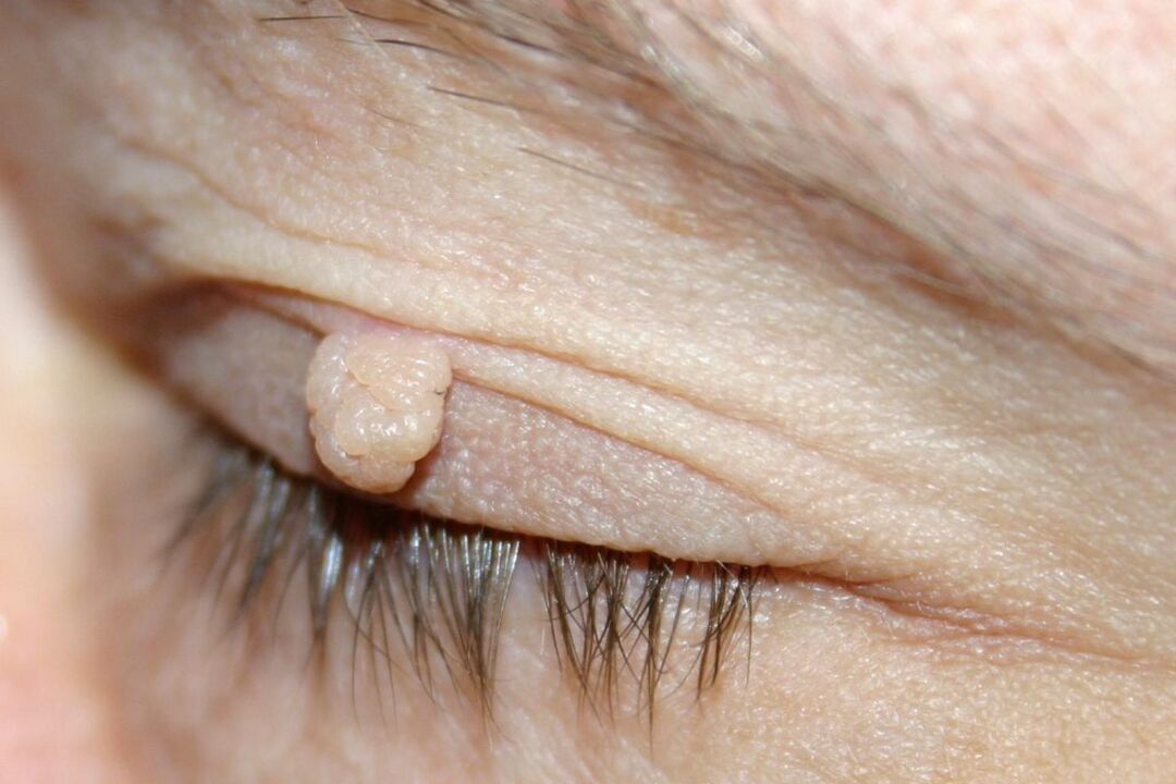 Symptomer vum Papilloma op der Auge